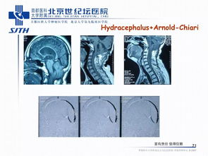 精品课件 内镜技术在神经外科中的应用 北京世纪坛医院胡志强